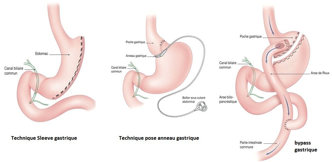 chirurgie obésité tunisie