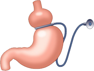 anneau gastrique pour qui