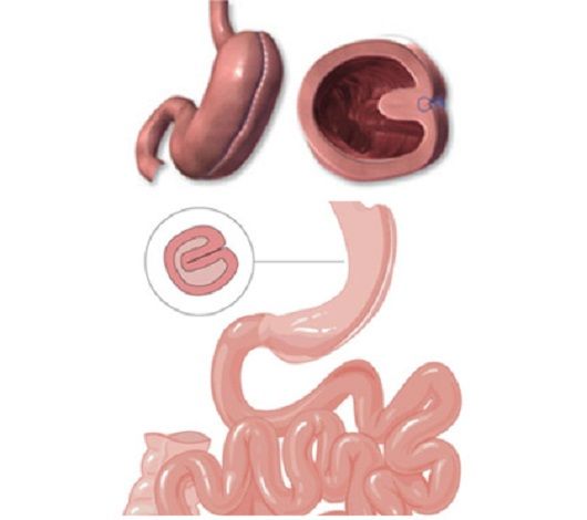 tarif plicature gastrique